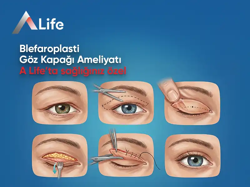 Blefaroplasti Nedir? | Blefaroplasti Nasıl Yapılır?